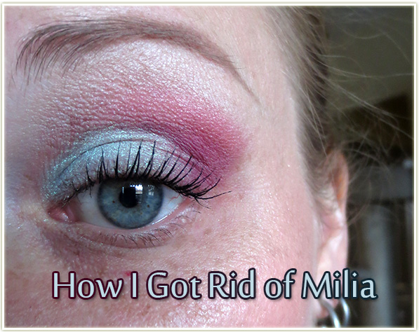 Eyes treatment under milia home 41 Tips