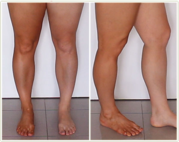 My right leg (your visual left) covered with St. Tropez Self Tan Classic Bronzing Mousse, left leg has nothing on it